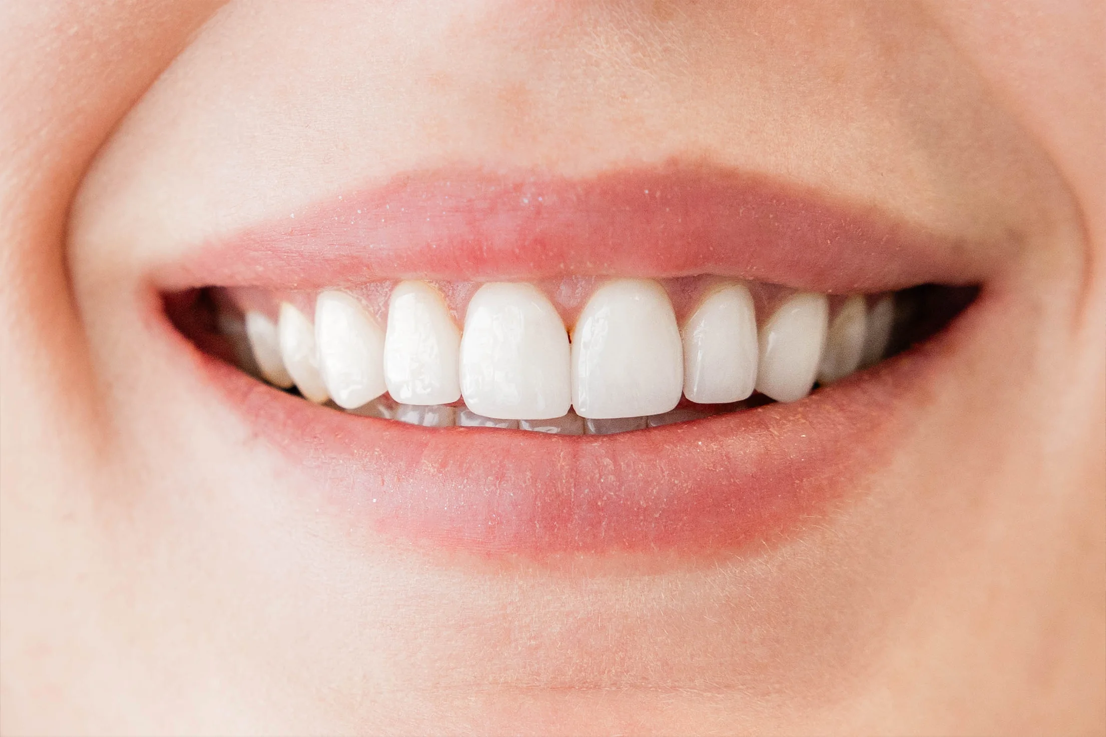 Close-up of a natural, even smile after cosmetic treatment at Vivid Specialized Dentistry in Edmonton