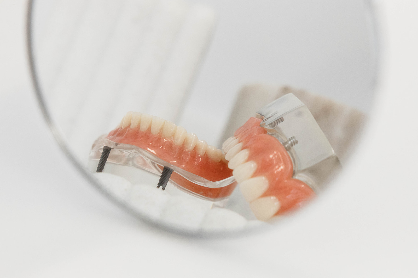 Implant-supported denture reflected in a dental mirror
